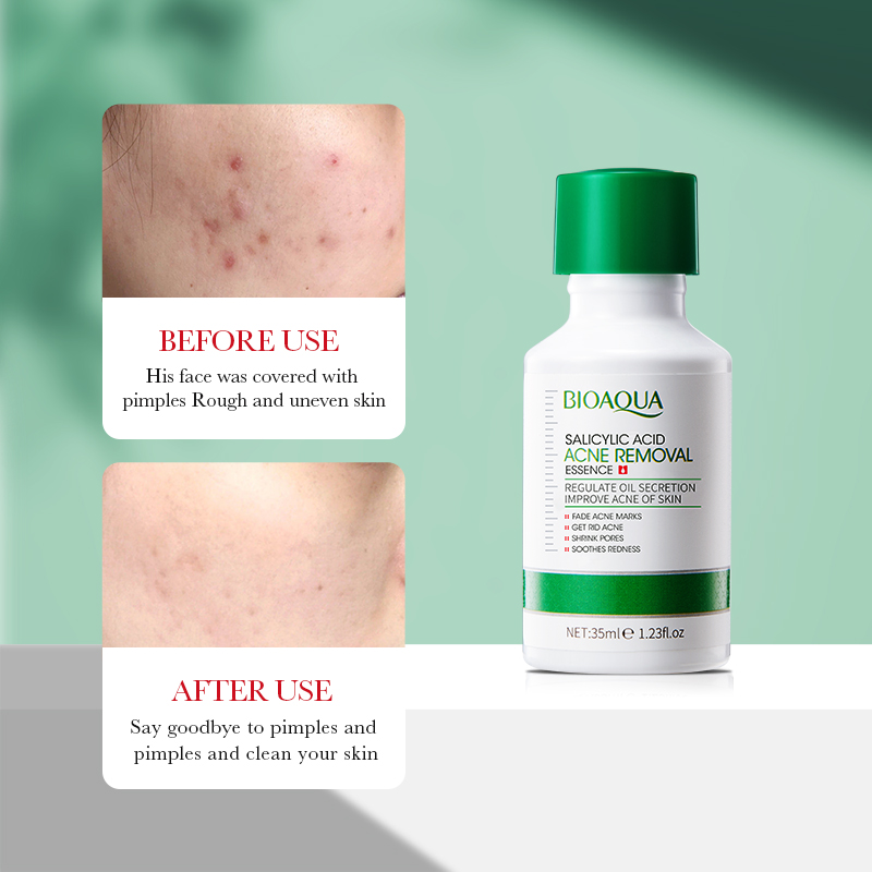 35ml bioaoa ácido salicílico a - Salicylic Acid Blackhead Remover avaliação e preço