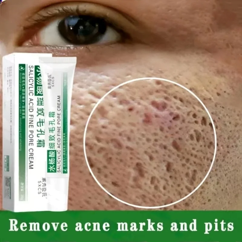 Ácido salicílico poros limpeza - Salicylic Acid Blackhead Remover avaliação e preço