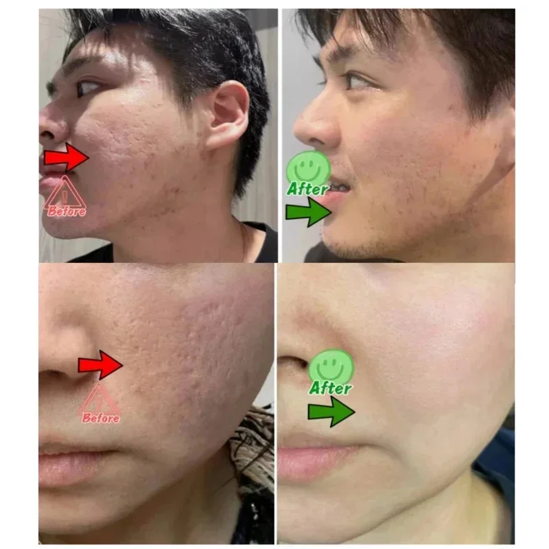 Ácido salicílico poros limpeza - Salicylic Acid Blackhead Remover avaliação e preço