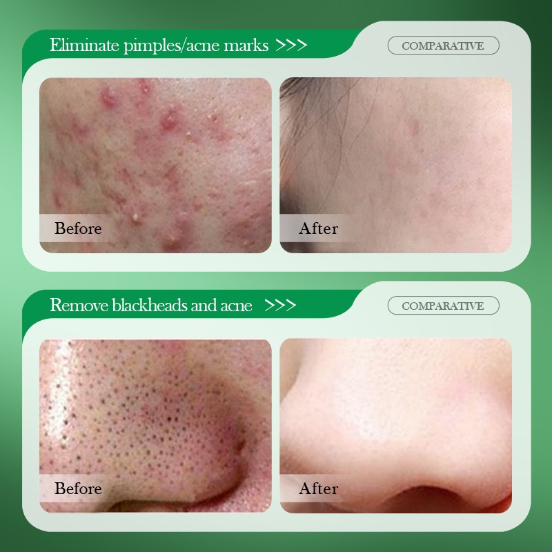 Creme de Tratamento para Acne  - Salicylic Acid Blackhead Remover avaliação e preço